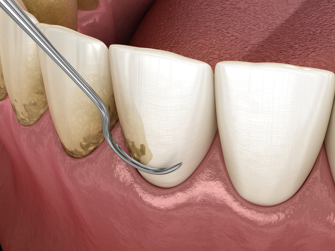 curetaje dental